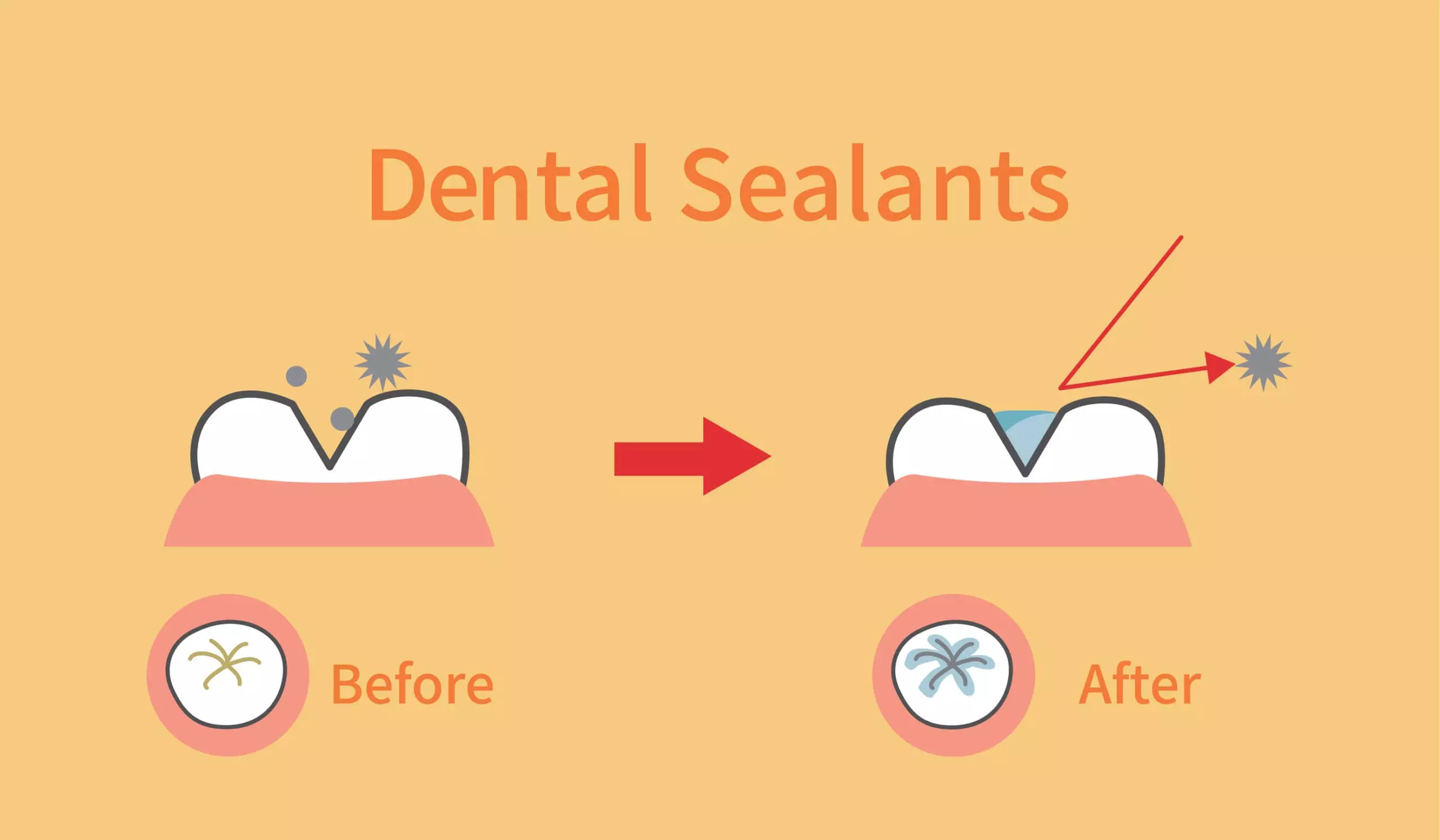 Dental sealants for children